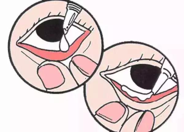 正确的方法应该是将眼药水滴入结膜囊内(下眼皮和眼球之间的间隙)