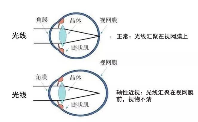 真性近视能治愈吗?不能!